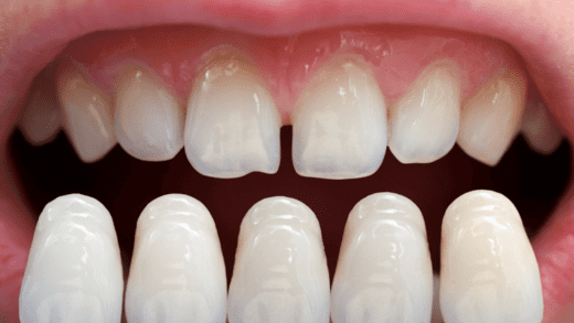 How Long Do Porcelain Veneers Last