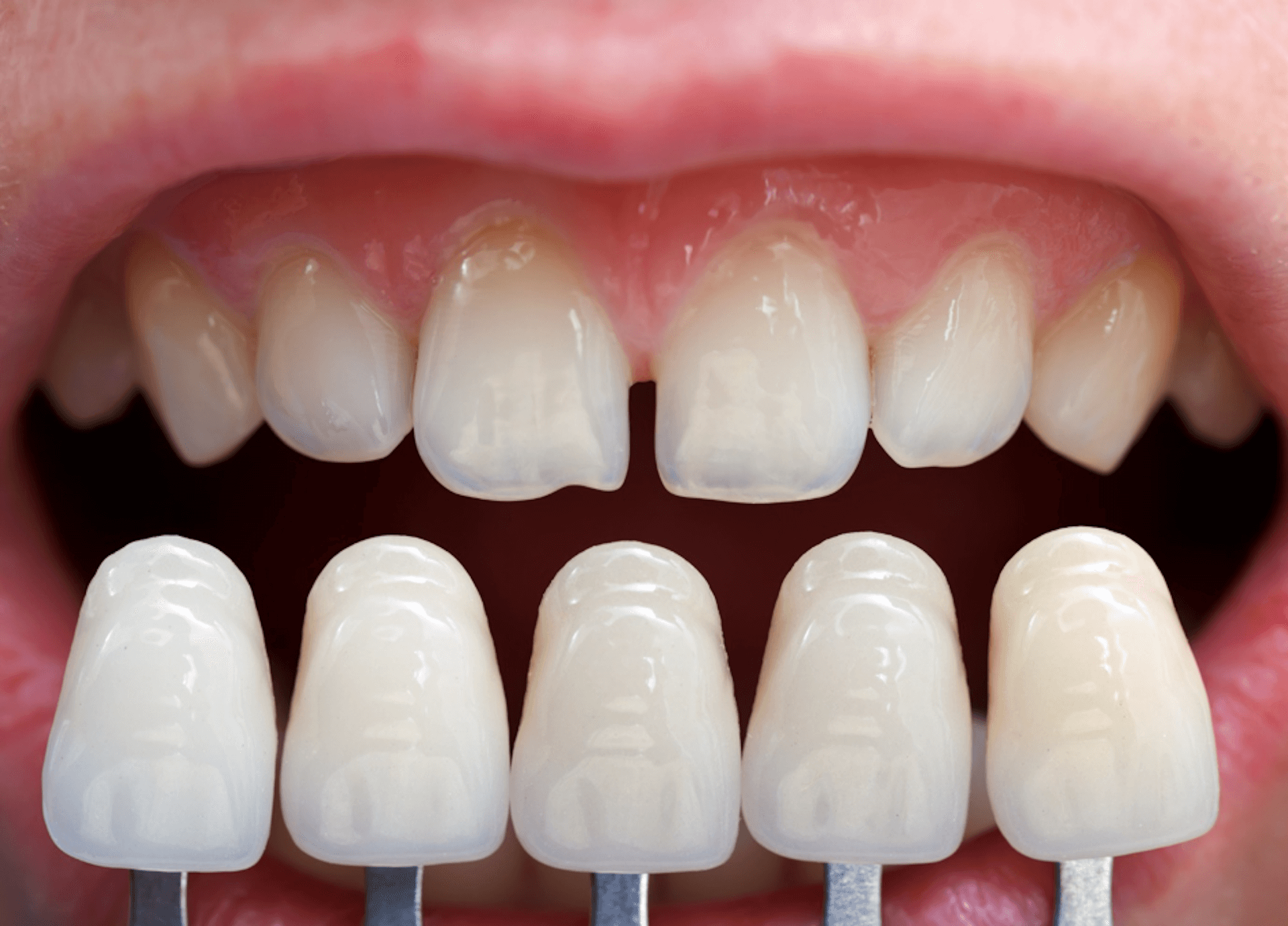 How Long Do Porcelain Veneers Last? GetSetHappy
