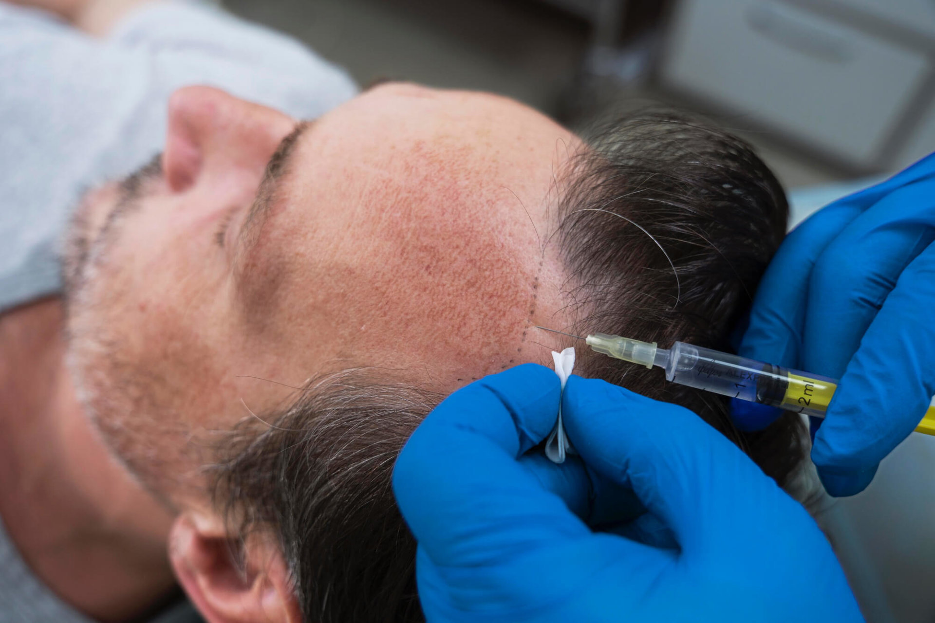 Hair Transplant Recovery: What To Expect And How To Take Care Of Your New Hair | GetSetHappy